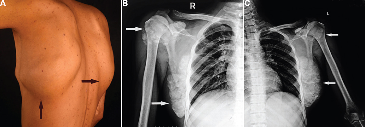 (A) Bilateral scapular masses (arrows). (B) Chunks of calcification over the right glenohumeral joint and scapula (arrows). (C) Chunks of calcification over the left glenohumeral joint and scapula (arrows).